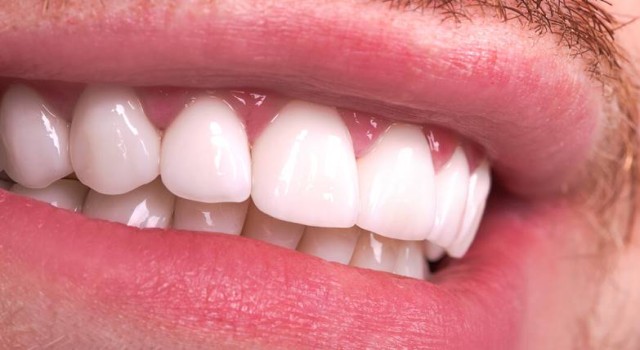 Uygun Fiyatlı Zirkonyum Kaplama Uygulaması